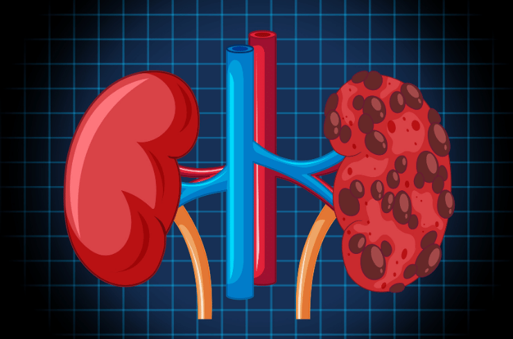 Acute Kidney Injury (AKI) Management