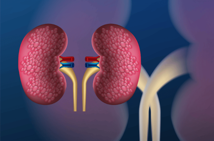 Chronic Kidney Disease (CKD) Management
